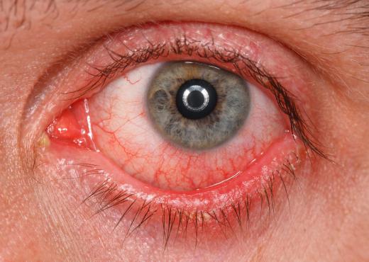 Topical Prednisolone Acetate: A Risky Eye Drop?